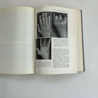 Vintage Medical Book Bunnell’s Surgery Of The Hand 1964 Photos Illustrations
