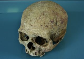 Antique Medical Demonstration Human Skull For Study,  Pathology,  Dentistry