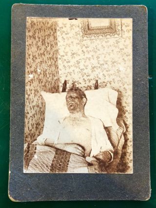 Antique Sepia Tone Post Mortem Cabinet Card Image Graphic Medical