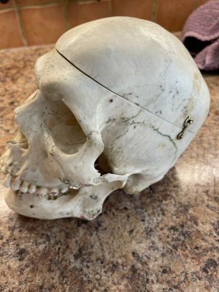 Antique Medical Skull Doctors In Transit Case.  Rare